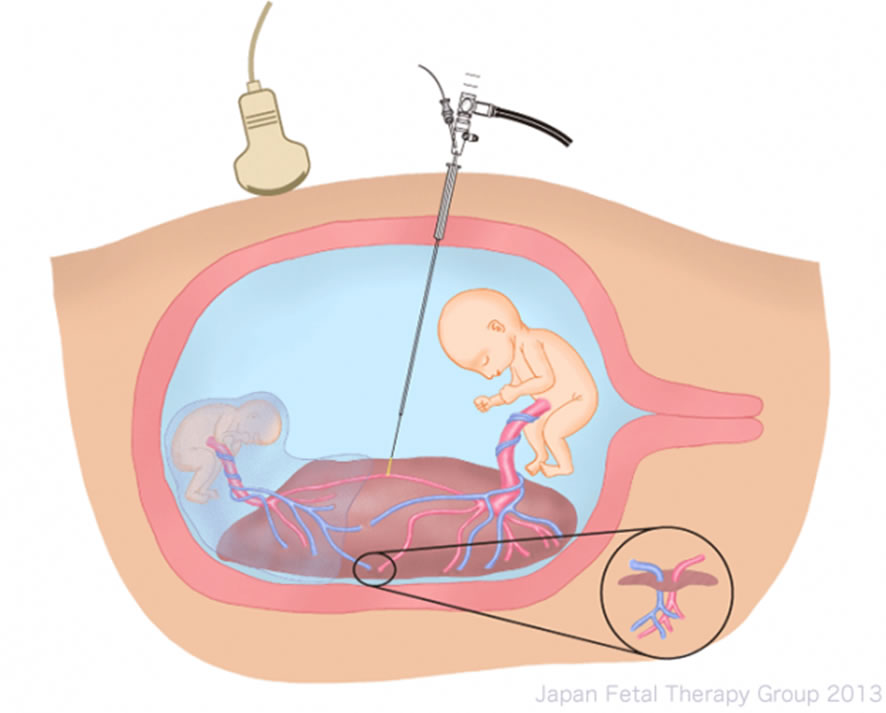 双胎間輸血症候群（TTTS）に対する胎児鏡下胎盤吻合血管レーザー凝固術（FLP）イメージ